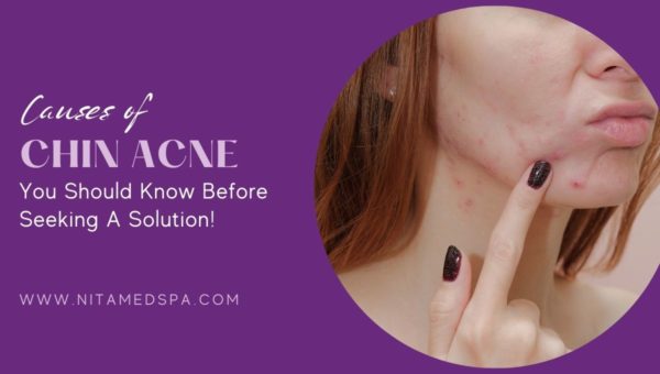 causes-of-chin-acne-you-should-know-before-seeking-a-solution