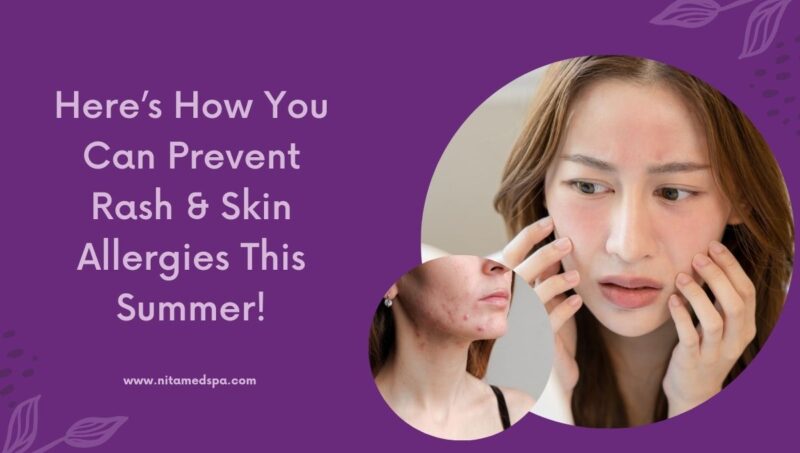 Here’s How You Can Prevent Rash & Skin Allergies This Summer! - Nita ...